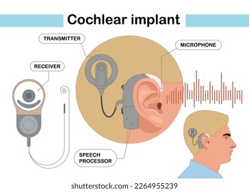 Cochlear implant device electrically stimulates nerve medical aid ear sound wave adults hard middle exam. Modern vector illustration in flat style