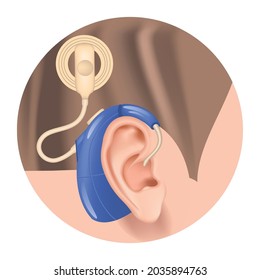 Cochlear implant. Hearing aid in the ear. Sensorineural hearing loss. Deafness treatment. Prosthesis for the auditory nerve. Hearing loss compensation. Vector illustration