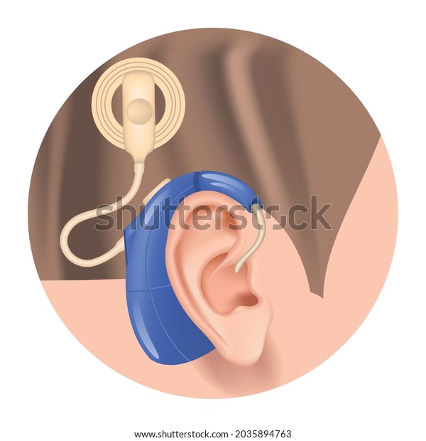 Cochlear implant.\
Hearing aid in the ear. Sensorineural hearing loss. Deafness\
treatment. Prosthesis for the auditory nerve. Hearing loss\
compensation. Vector\
illustration