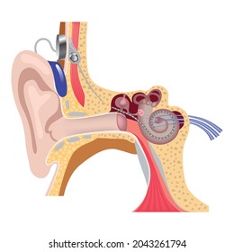 Cochlear Implantation System. Hearing Back With Inner Ear Surgery. Electron Array. Vector Illustration