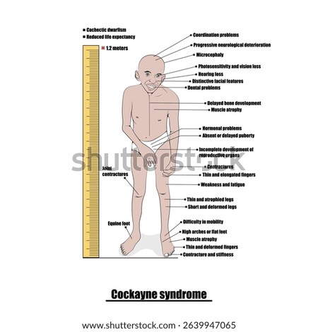 Cockayne syndrome, rare genetic disease, rapid patient wear-off.