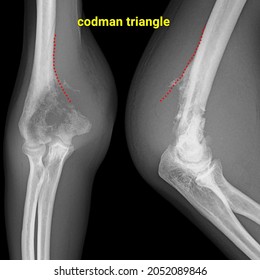 Codman triangle osteosarcoma aggresive bone tumor vector