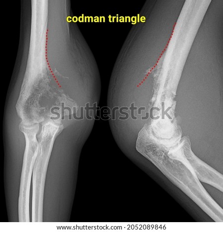 Codman triangle osteosarcoma aggresive bone tumor vector