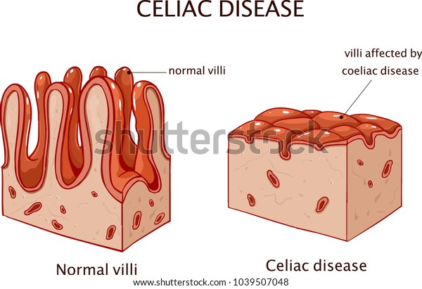 乳糜泻或乳糜泻 小肠显示乳糜泻表现为绒毛的钝化 库存矢量图 免版税