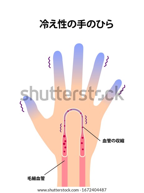 冷たい手の血液循環イラスト 指先の冷えに敏感 日本語 翻訳 冷たい手 毛細血管 血管収縮 のベクター画像素材 ロイヤリティフリー