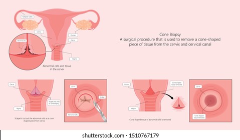 Cold knife cone biopsy Loop Electrosurgical Excision Procedure LEEP Large Loop Excision of the Transformation Zone LLETZ remove tissue from the cervix for precancerous cell laser diathermy per treat