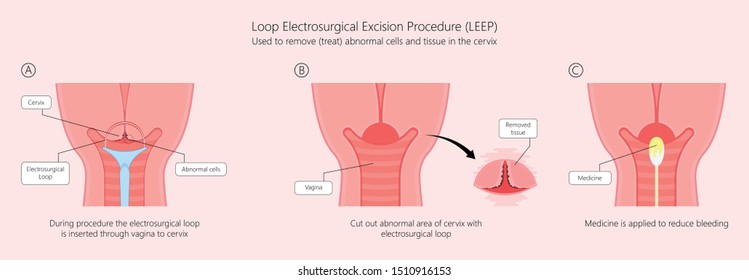 Cold knife cone biopsy Loop Electrosurgical Excision Procedure LEEP Large Loop Excision of the Transformation Zone LLETZ remove tissue from the cervix for precancerous cell laser diathermy per treat