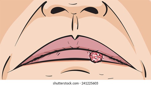 Cold Sore