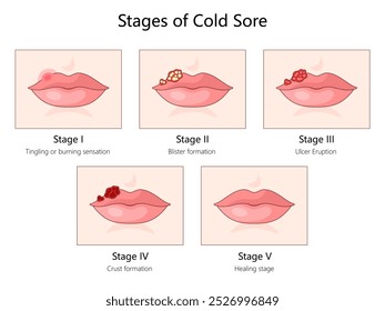 herpes labial, desde la sensación inicial de hormigueo hasta la formación de ampollas, la erupción de úlceras, la formación de costras y el diagrama de curación Ilustración vectorial esquemática dibujada a mano. Ilustración educativa de ciencia médica