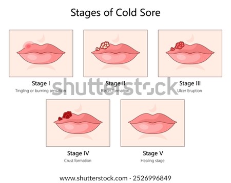 cold sore, from the initial tingling sensation to blister formation, ulcer eruption, crusting, and healing diagram hand drawn schematic vector illustration. Medical science educational illustration