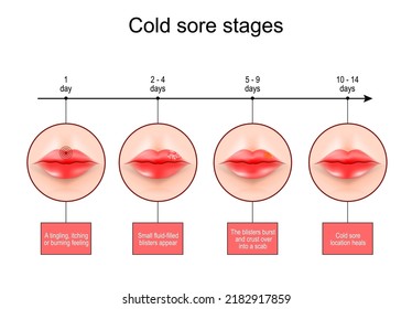 Cold Sore Stages. Lips With Symptoms Of Herpes Labialis. Scale From Burning Feeling To Blisters Formation And Cold Sore Location Heals. Vector Infographics