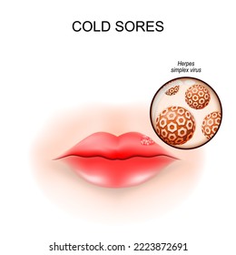 Cold sores in the lip. fever blisters. Close-up of a Herpes Simplex virus. Vector illustration