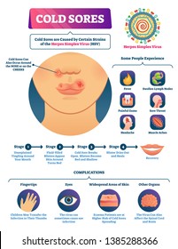 Cold sores vector illustration. Medical labeled herpes simplex virus scheme. Anatomical symptoms, full cycle stages collection and disease complications. Nose and cheeks tingling feeling explanation.