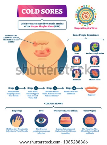 Cold sores vector illustration. Medical labeled herpes simplex virus scheme. Anatomical symptoms, full cycle stages collection and disease complications. Nose and cheeks tingling feeling explanation.