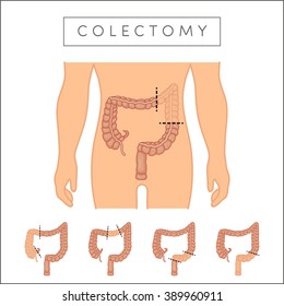 Colectomy - surgical removal of the colon's parts. Types of colectomy, vector. 