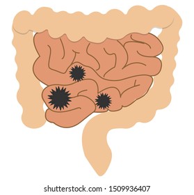 Colic in the gut isolated on a white background.