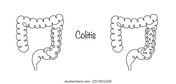 Colite. Processo inflamatório agudo ou crônico no intestino grosso. Ilustração de linha desenhada à mão sobre um tema médico. Vetor.