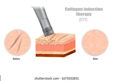 Collagen induction therapy (CIT). DERMAPEN. Microneedle stamping device. 