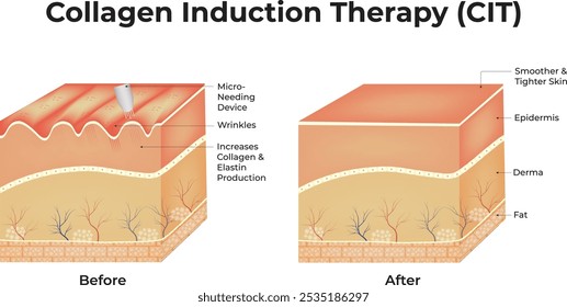 Terapia de indução de colágeno (CIT) Ilustração de vetor, Dermapen, Microneedle stamping device.