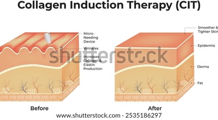Collagen Induction Therapy (CIT) Vector Illustration, Dermapen, Microneedle stamping device.
