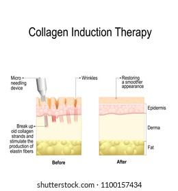 Collagen induction therapy (microneedling) is a surgical for remove wrinkles, scars, stretch, marks, pigmentation. procedure repeatedly puncturing the skin with tiny sterile needles