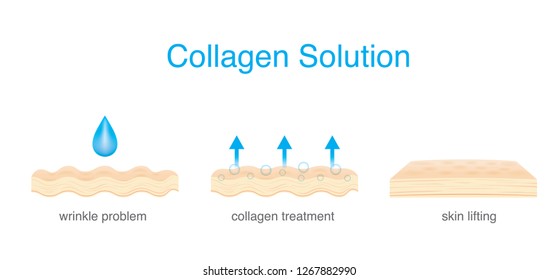 Collagen Treatment wrinkle on Skin to be smoother and younger. Illustration about beauty and medical.