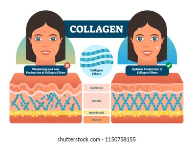 Collagen vector illustration. Medical and anatomical labeled scheme with fibers, epidermis, hypodermis and muscle. Weakening low and optimal production compared diagram. Skin care and biology basics.