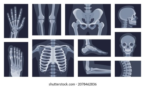 Colección de diferentes partes del cuerpo humano roentgen imágenes vectoriales ilustración plana. Establecer x rayos en la cabeza, manos, piernas, torso, pecho, cadera, codo, rodilla, esqueleto de columna aislado en blanco