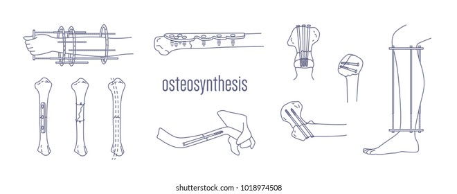 Collection of fractured bones and limbs fixed with metal implantable devices drawn with contour lines on white background. Bundle of osteosynthesis constructions. Monochrome vector illustration. 