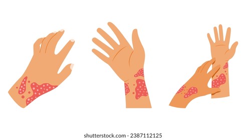 Collection of Hands Experiencing Rash Vector illustration