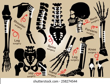 Collection Of Orthopedic Surgery ( Internal Fixation By Plate And Screw )( Skull , Head , Neck , Spine , Sacrum , Arm , Forearm , Hand , Elbow ,shoulder , Pelvic , Thigh , Hip , Knee , Leg , Foot )