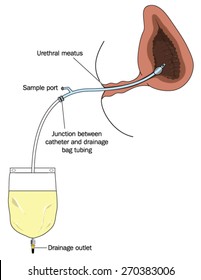 Collection of urine from the bladder using a catheter and collection bag. Created in Adobe Illustrator.  Contains transparencies.  EPS 10.
