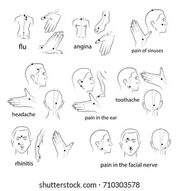 Collection of vector schemes of acupuncture points that are masked by balm from pain.