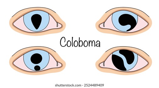 Coloboma. Violação congênita ou adquirida da integridade da membrana ocular, na qual ocorre o seu subdesenvolvimento. Variantes desenhadas à mão da manifestação do coloboma. Ilustração vetorial.