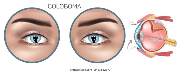 Coloboma is a congenital condition characterized by a gap or notch in one of the eyes structures, typically affecting the iris, retina, choroid, or optic disc. eye diseases and syndromes vector