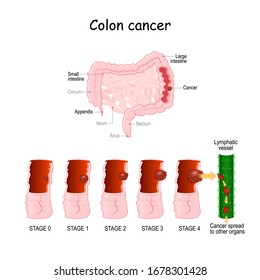 Colon Cancer. Colorectal Oncology. Development Of A Malignant Tumor From 0 To 4 Stages. Medical Diagram. Vector Illustration. Digestive System.