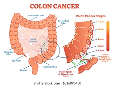 Colon cancer medical vector illustration scheme, anatomical diagram with cancer stages and spreading to other organs. 