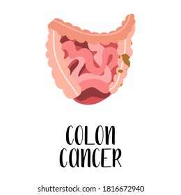 Colon cancer. Oncology. Intestines diseases. Gastroenterology. Vector flat illustration. Perfect for flyer, medical brochure, banner, landing page, website