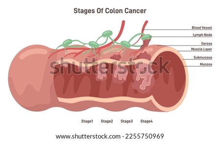 Colon cancer. Stage of development of a malignant tumor in human dygestive system organ. Cancer cells develop on colon wall and lymph node. Flat vector illustration
