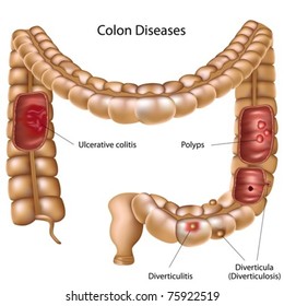 Colon pathologies