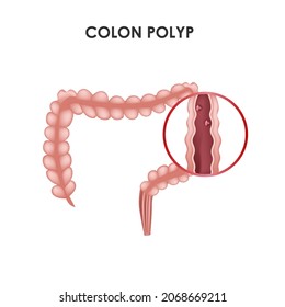 Colon Polyp. Medical Vector Illustration