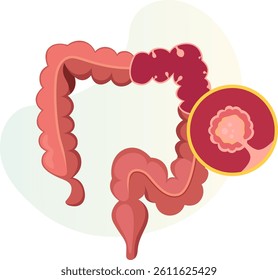 Colon Polyps  - An Abnormal Tissue Growths - Stock Illustrations as EPS 10 File