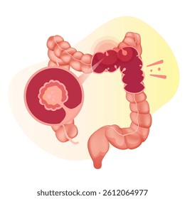 Colon Polyps  - An Abnormal Tissue Growths - Stock Illustrations as EPS 10 File