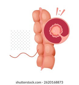 Colon Polyps  - An Abnormal Tissue Growths - Stock Illustrations as EPS 10 File
