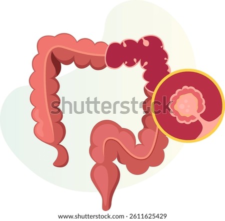 Colon Polyps  - An Abnormal Tissue Growths - Stock Illustrations as EPS 10 File