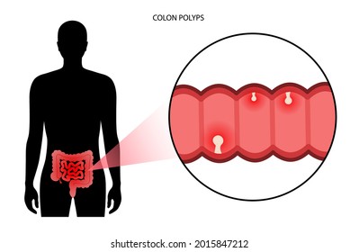 Colon polyps concept. Hyperplastic, inflammatory and hamartomatous polyp. Development of tumor in large intestine. Pain and inflammation in human body. Internal organs exam flat vector illustration.