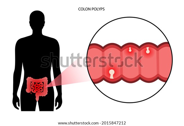 Colon polyps concept. Hyperplastic,\
inflammatory and hamartomatous polyp. Development of tumor in large\
intestine. Pain and inflammation in human body. Internal organs\
exam flat vector\
illustration.