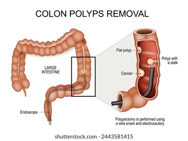 Colon polyps removal. Colonoscopy and Polypectomy. Colon cancer prevention. Human large intestine with Endoscope. Close-up of a cross section part of the bowel with Cancer, Flat polyp