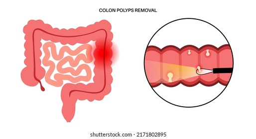 Colon polyps removal. Hyperplastic, inflammatory and hamartomatous polyp. Development of tumor in large intestine. Pain and inflammation in human body. Internal organs exam flat vector illustration.