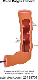 Colon Polyps Removal Science Design Vector Illustration DDiagram